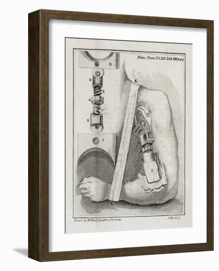 Bone-setting Mechanism, 18th Century-Middle Temple Library-Framed Photographic Print