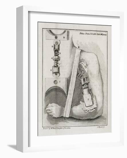 Bone-setting Mechanism, 18th Century-Middle Temple Library-Framed Photographic Print