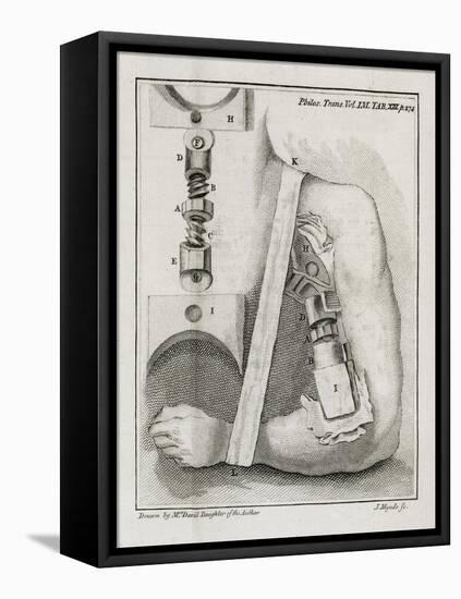 Bone-setting Mechanism, 18th Century-Middle Temple Library-Framed Stretched Canvas