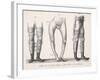 Bow Legs and Their Treatment with Apparatus Intended to Straighten Them-Langlume-Framed Art Print