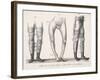 Bow Legs and Their Treatment with Apparatus Intended to Straighten Them-Langlume-Framed Art Print