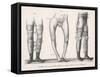 Bow Legs and Their Treatment with Apparatus Intended to Straighten Them-Langlume-Framed Stretched Canvas