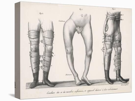 Bow Legs and Their Treatment with Apparatus Intended to Straighten Them-Langlume-Stretched Canvas