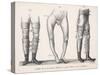 Bow Legs and Their Treatment with Apparatus Intended to Straighten Them-Langlume-Stretched Canvas