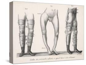 Bow Legs and Their Treatment with Apparatus Intended to Straighten Them-Langlume-Stretched Canvas