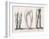 Bow Legs and Their Treatment with Apparatus Intended to Straighten Them-Langlume-Framed Art Print