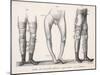 Bow Legs and Their Treatment with Apparatus Intended to Straighten Them-Langlume-Mounted Art Print
