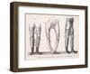 Bow Legs and Their Treatment with Apparatus Intended to Straighten Them-Langlume-Framed Art Print