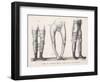 Bow Legs and Their Treatment with Apparatus Intended to Straighten Them-Langlume-Framed Art Print