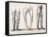 Bow Legs and Their Treatment with Apparatus Intended to Straighten Them-Langlume-Framed Stretched Canvas