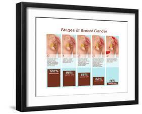 Breast Cancer Stages, Illustration-Gwen Shockey-Framed Art Print
