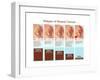 Breast Cancer Stages, Illustration-Gwen Shockey-Framed Art Print