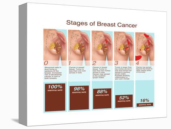 Breast Cancer Stages, Illustration-Gwen Shockey-Stretched Canvas