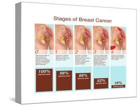 Breast Cancer Stages, Illustration-Gwen Shockey-Stretched Canvas
