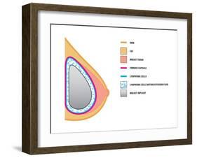 Breast Implants and Cancer-Science Source-Framed Giclee Print