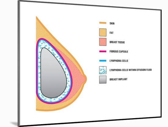 Breast Implants and Cancer-Science Source-Mounted Giclee Print