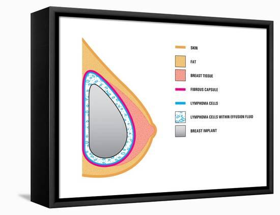 Breast Implants and Cancer-Science Source-Framed Stretched Canvas