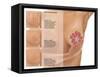 Breast Self Examination-Gwen Shockey-Framed Stretched Canvas