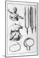 Breast Surgery, 1751-1777-Denis Diderot-Mounted Giclee Print