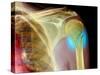 Broken Upper Arm Bone, X-ray-Du Cane Medical-Stretched Canvas