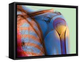 Broken Upper Arm Bone, X-ray-Du Cane Medical-Framed Stretched Canvas