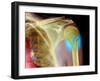 Broken Upper Arm Bone, X-ray-Du Cane Medical-Framed Photographic Print