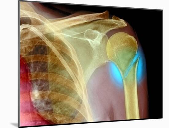 Broken Upper Arm Bone, X-ray-Du Cane Medical-Mounted Photographic Print