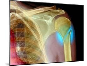 Broken Upper Arm Bone, X-ray-Du Cane Medical-Mounted Photographic Print