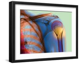 Broken Upper Arm Bone, X-ray-Du Cane Medical-Framed Photographic Print