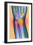 Broken Wrist, X-ray-Du Cane Medical-Framed Photographic Print