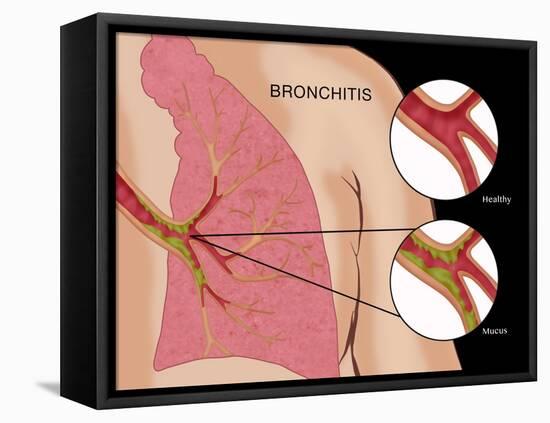 Bronchitis-Monica Schroeder-Framed Stretched Canvas