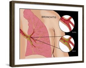 Bronchitis-Monica Schroeder-Framed Giclee Print