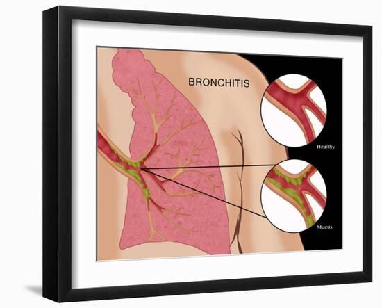 Bronchitis-Monica Schroeder-Framed Giclee Print