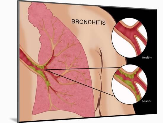 Bronchitis-Monica Schroeder-Mounted Giclee Print