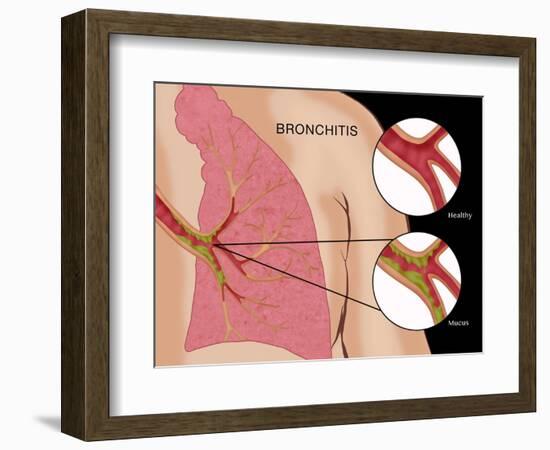 Bronchitis-Monica Schroeder-Framed Giclee Print