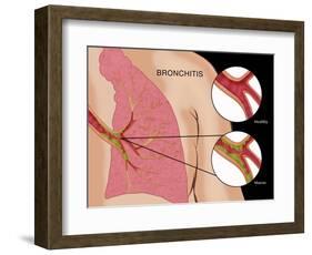 Bronchitis-Monica Schroeder-Framed Giclee Print