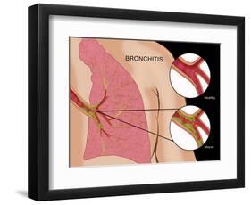 Bronchitis-Monica Schroeder-Framed Giclee Print