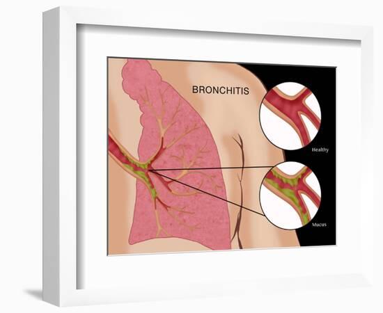 Bronchitis-Monica Schroeder-Framed Giclee Print