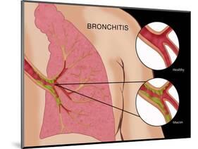 Bronchitis-Monica Schroeder-Mounted Giclee Print