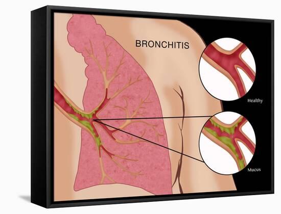 Bronchitis-Monica Schroeder-Framed Stretched Canvas