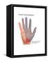 Carpal Tunnel Syndrome, Illustration-Gwen Shockey-Framed Stretched Canvas