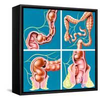 Causes of Constipation-John Bavosi-Framed Stretched Canvas