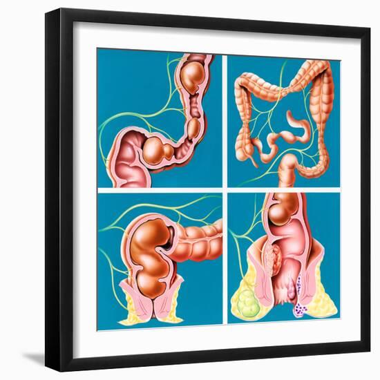 Causes of Constipation-John Bavosi-Framed Premium Photographic Print