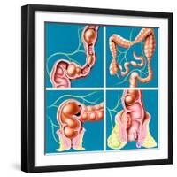 Causes of Constipation-John Bavosi-Framed Premium Photographic Print