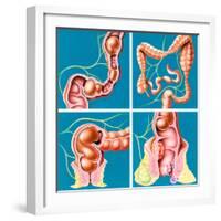 Causes of Constipation-John Bavosi-Framed Premium Photographic Print