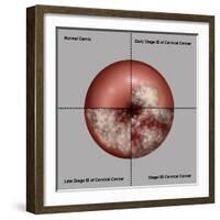 Cervical Cancer Progression, Illustration-Gwen Shockey-Framed Giclee Print