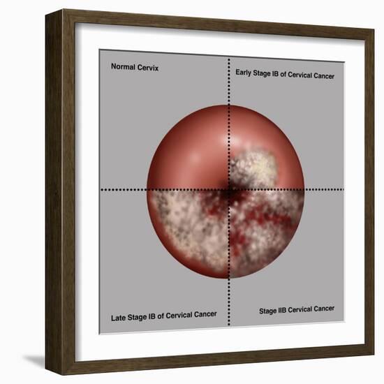 Cervical Cancer Progression, Illustration-Gwen Shockey-Framed Giclee Print