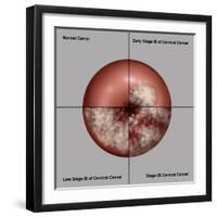 Cervical Cancer Progression, Illustration-Gwen Shockey-Framed Giclee Print