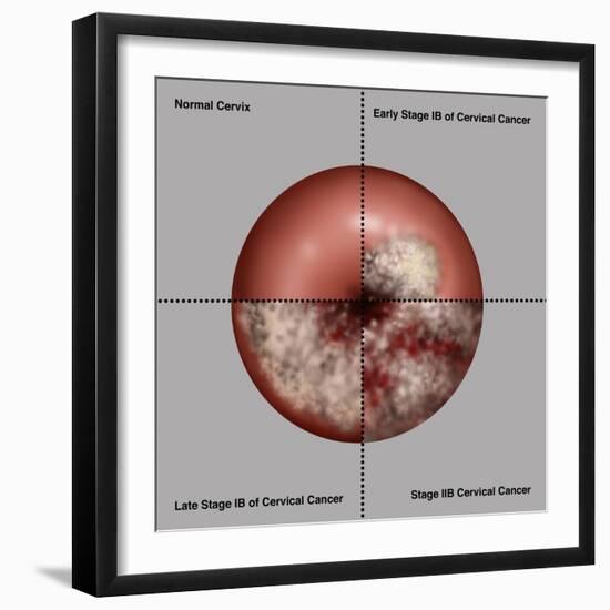 Cervical Cancer Progression, Illustration-Gwen Shockey-Framed Giclee Print