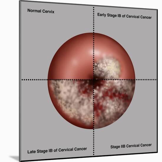 Cervical Cancer Progression, Illustration-Gwen Shockey-Mounted Giclee Print